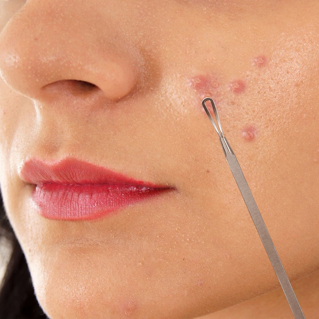 7-Piece Blackhead Extractor Kit detail view 9