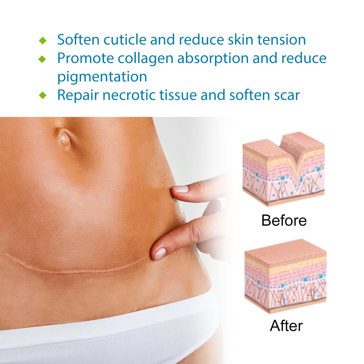 Silicone scar patch applied to skin