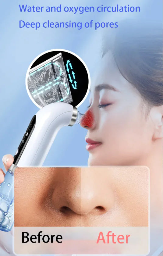 Rechargeable Blackhead Remover Vacuum — Adjustable Pore Cleaner - Image 8
