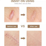 Reusable Silicone Scar Tape for Skin Repair