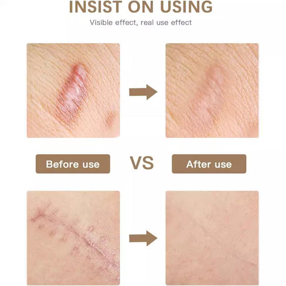Reusable Silicone Scar Tape for Skin Repair product image 3